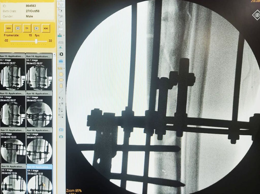 HEF realiza primeira cirurgia ortopédica usando técnica Ilizarov